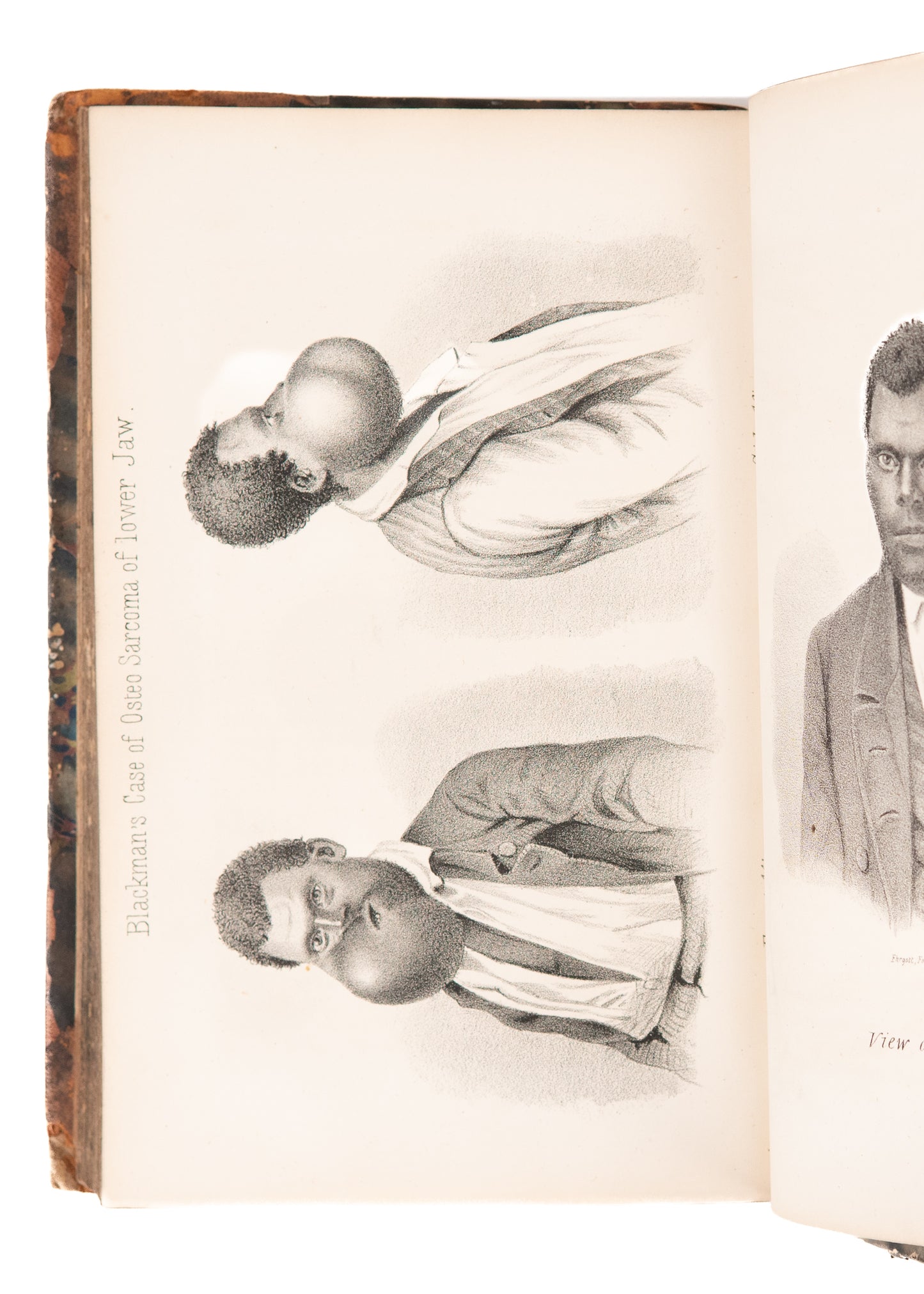 1860 DENTISTRY IN WILD WEST. Dentures Swallowed, Oral Surgery on "Negroes," Chloroform Deaths.