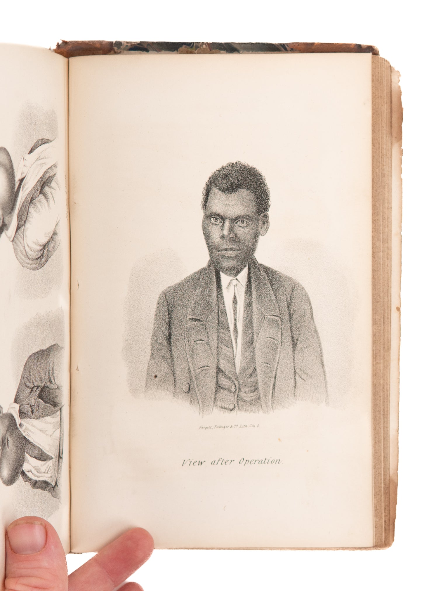 1860 DENTISTRY IN WILD WEST. Dentures Swallowed, Oral Surgery on "Negroes," Chloroform Deaths.